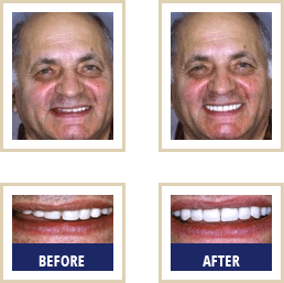 Before After 01