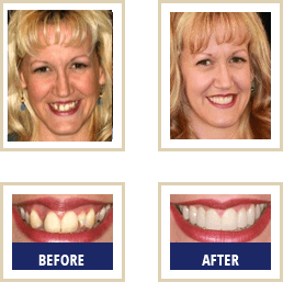 Before After 04