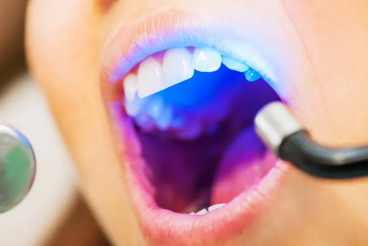 Close-up of a mouth receiving a blue light dental treatment during a checkup